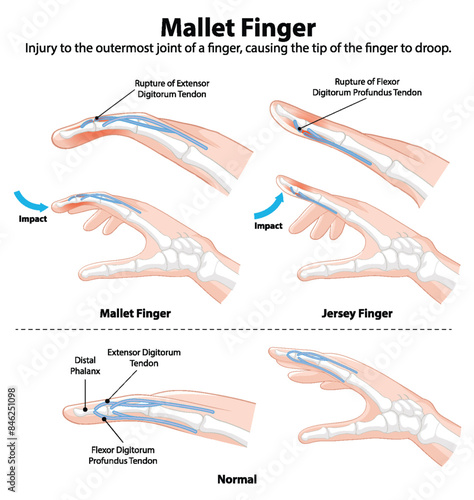 Diagram showing mallet and jersey finger injuries