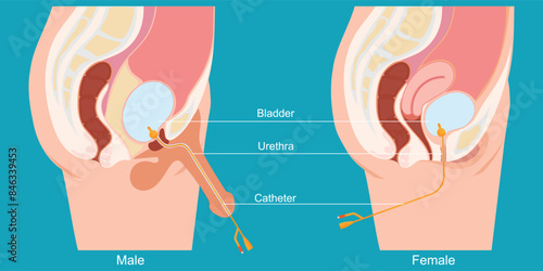 Urinary catheter in the male body and female body.
