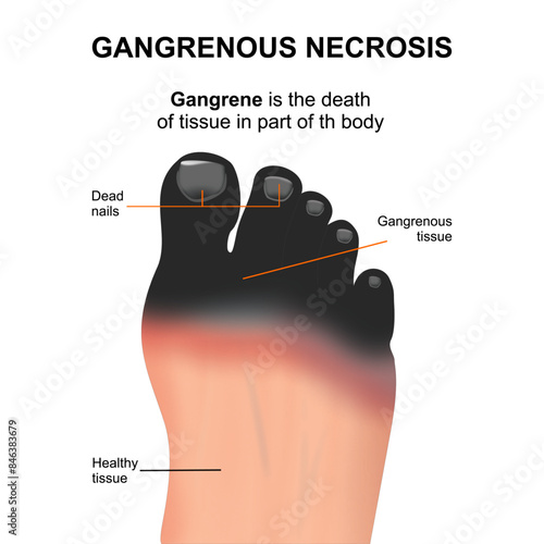 Gangrene on foot illustration edematous myonecrosis