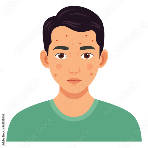 A cartoon depiction of a youthful male displaying acne on his facial skin