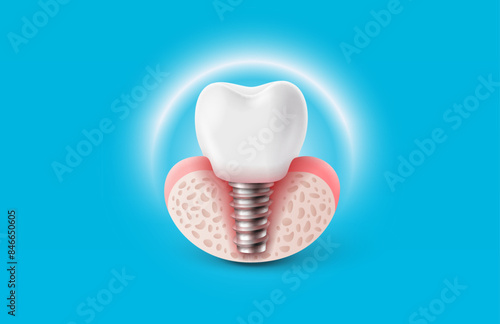 Dental implantation, tooth restoration, symbol on a white background. Vector illustration