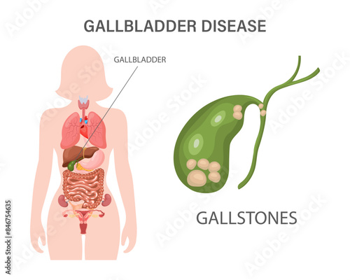 Gallbladder diseases infographic banner. Gallstone disease, cancer, cholangitis or polyps of the digestive system. Medicine and healthcare. Illustration.