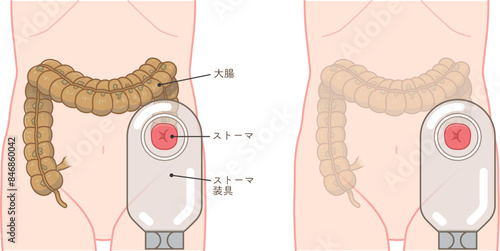 人工肛門、ストーマ、大腸、イラスト、illustration