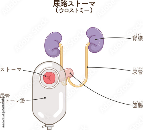 尿路ストーマ、ストーマ、ウロストミー、urostomy、オストメイト、大腸、小腸、膀胱、イラスト、illustration