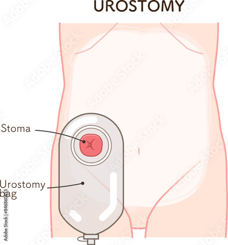 尿路ストーマ、ストーマ、ウロストミー、urostomy、オストメイト、大腸、小腸、膀胱、イラスト、illustration