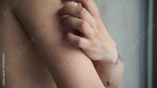 The guy's shoulder itches from allergies.
Allergies on the body.
Scabies in a man.
Man scratching his hand photo