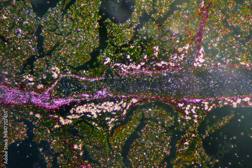 Micrograph of lobar pneumonia grey hepatization stage photo