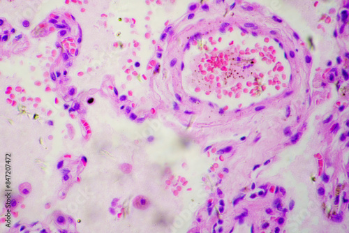 Micrograph of lobar pneumonia dissolution phase recovery stage photo