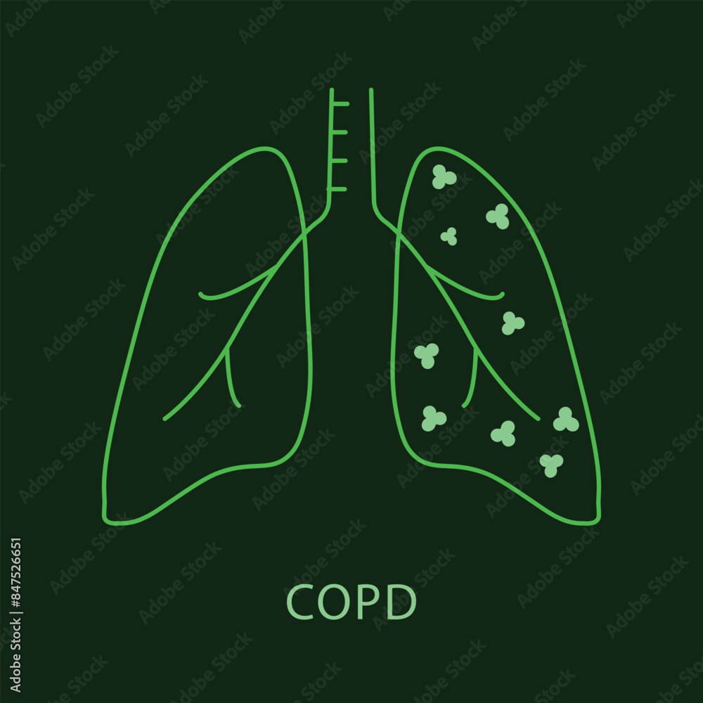 COPD Icon for Medical Use - Health and Respiratory Condition Vector with editable stroke. COPD Icon for Medical Use - Health and Respiratory Condition Vector with editable stroke.