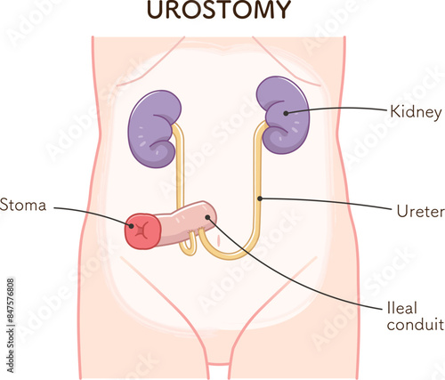 尿路ストーマ、ストーマ、ウロストミー、urostomy、オストメイト、大腸、小腸、膀胱、イラスト、illustration
