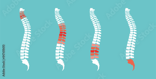 Back pain set. Osseochondrosis, hernia. Damaged dorsal disc. Four divisions of the spine. Cervical, thoracic, lumbar, sacral sections of the spine. Vector