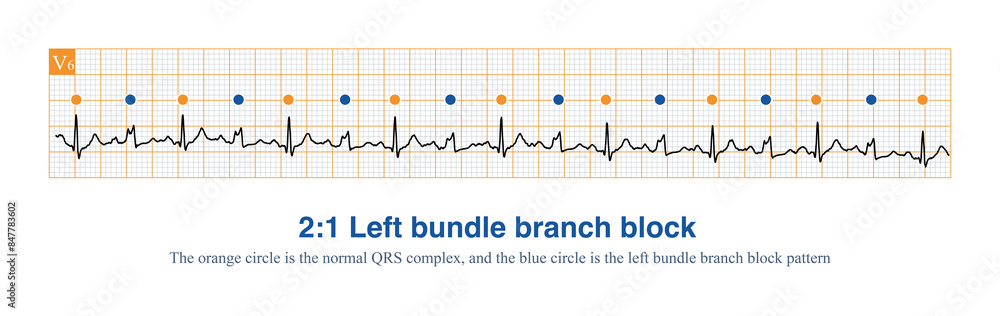 icd 10 code for new left bundle branch block