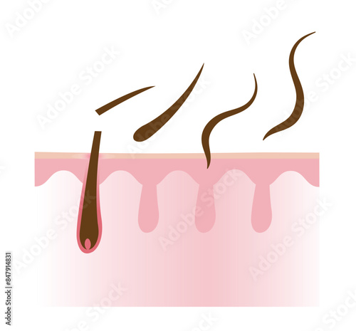 The cross section of hair losing with scalp layer vector illustration isolated on white background. Weak, brittle, fall hair to alopecia, baldness and hair loss. Hair anatomy and problem concept.