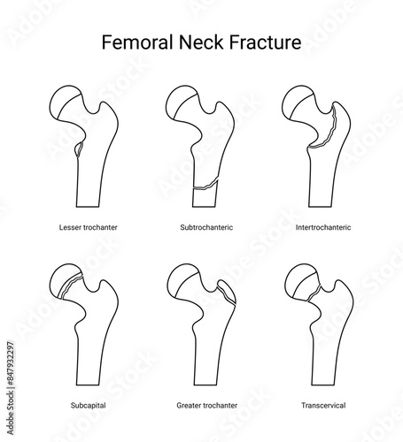 Types of femoral neck fracture in line style
