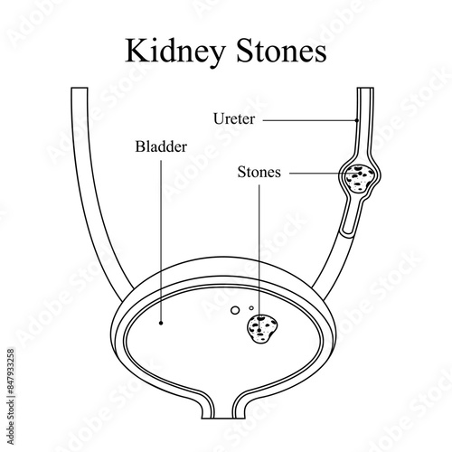 Diagram of kidney stones disease in sketch style