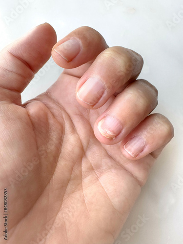Dry damaged yellow fingernails of a woman