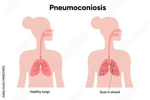Pneumoconiosis, dust in alveoli and healthy lungs