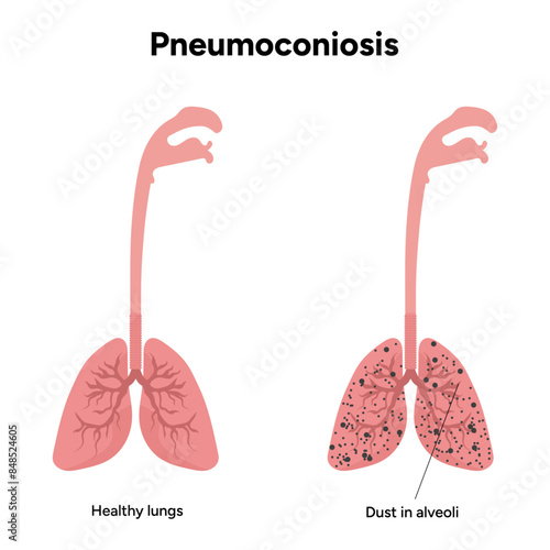 Pneumoconiosis, dust in alveoli and healthy lungs