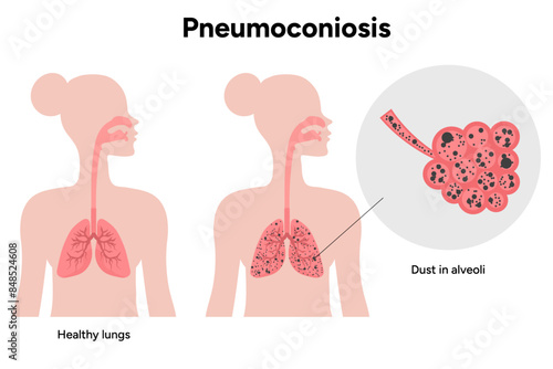 Pneumoconiosis, dust in alveoli and healthy lungs