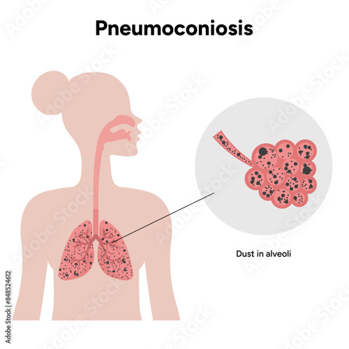 Pneumoconiosis, dust in alveoli 