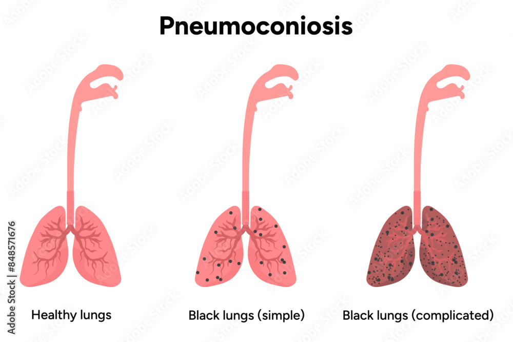 Pneumoconiosis, healthy and black lungs Pneumoconiosis, healthy and black lungs