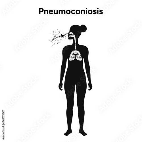 Pneumoconiosis, icons version 