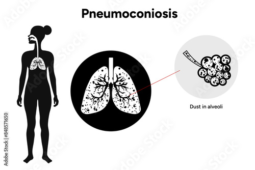 Pneumoconiosis, icons version 
