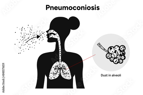 Pneumoconiosis, icons version lungs