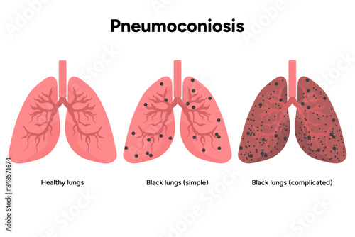 Pneumoconiosis, healthy and black lungs