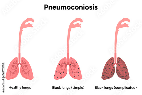 Pneumoconiosis, healthy and black lungs