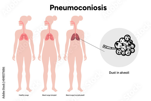 Pneumoconiosis, healthy and black lungs