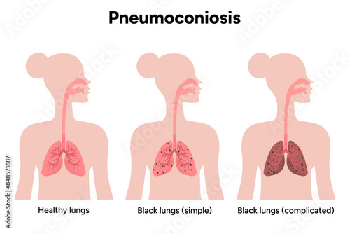 Pneumoconiosis, healthy and black lungs