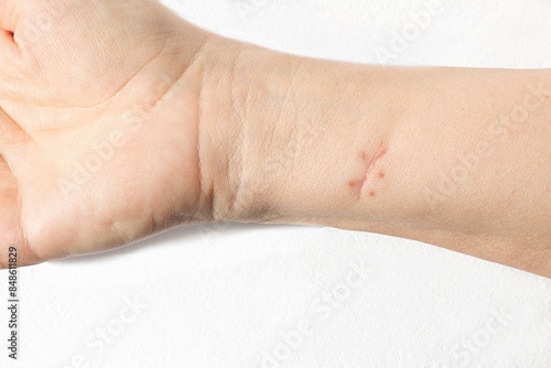 Scar from a sutured wound on white skin forearm. Isolated