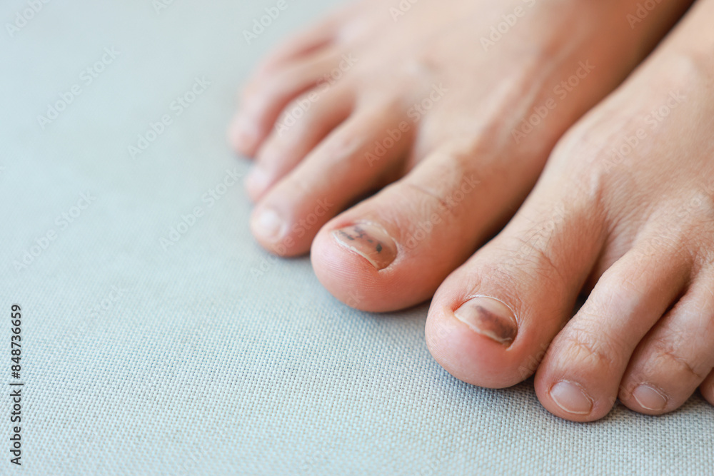 Subungual Hematoma on toenail are injuries of wearing shoes that are