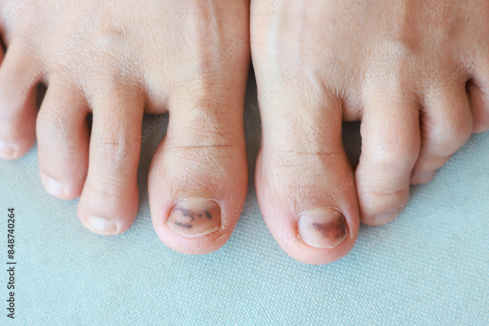 Subungual Hematoma on toenail are injuries of wearing shoes that are