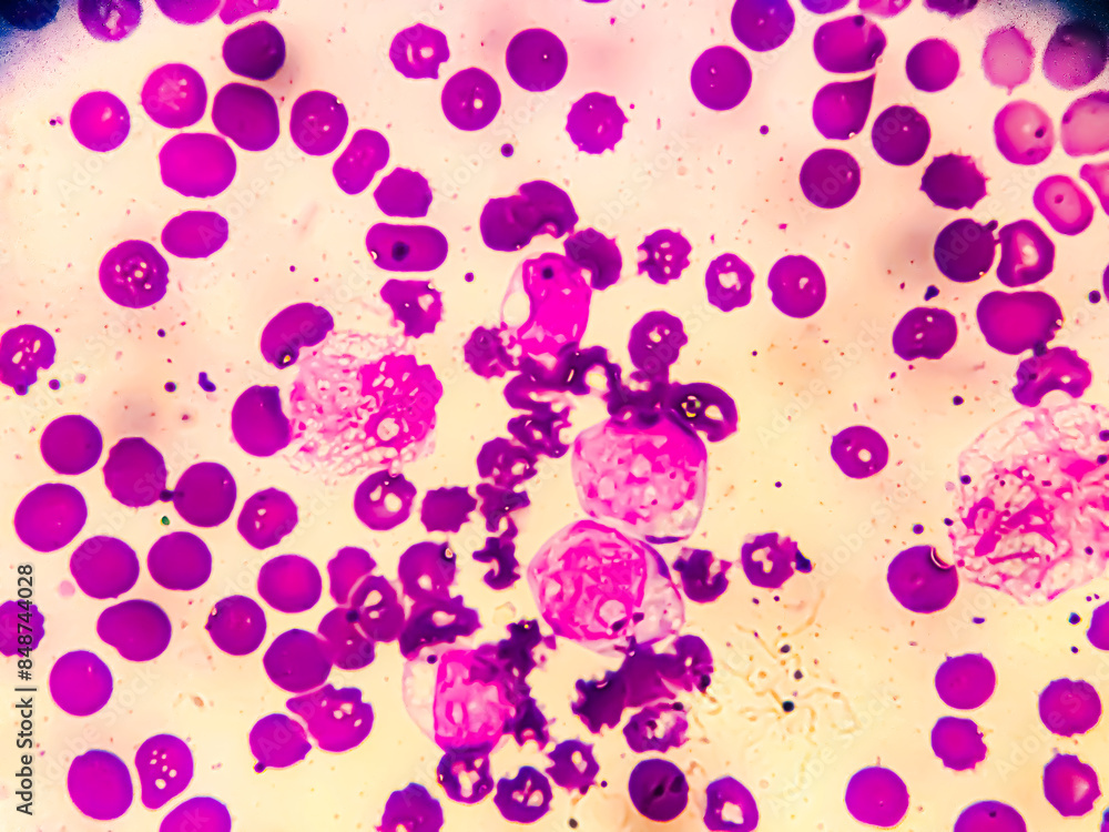 Chronic myeloid leukemia cells or CML, analyze by microscope. Blood ...