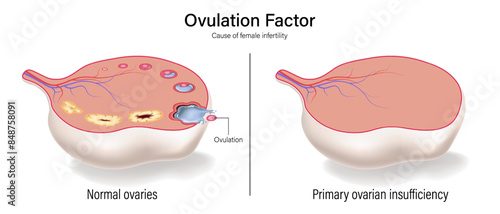 Female infertility vector. Comparison of normal ovaries and primary ovarian insufficiency. Ovulation factor. Female reproductive system.