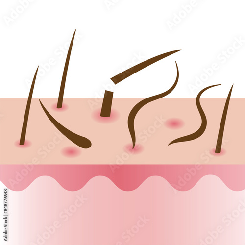 Hair fall with scalp layer vector illustration isolated on white background. Hair dry and brittle become weak and prone to breakage, shedding, alopecia and hair loss. Hair care and problem concept.