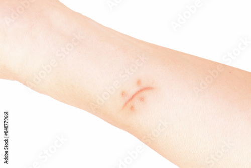 Scar of suture in a white skin femenine arm