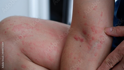 Картината върху платно Close up image of skin texture suffering severe urticaria or hives or kaligata on a man's thighs and arm