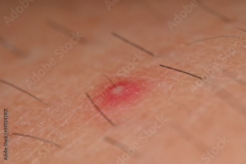 a Folliculitis on hair follicle