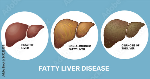 Fatty liver disease. Human liver disease. Healthcare illustration. Vector illustration. 