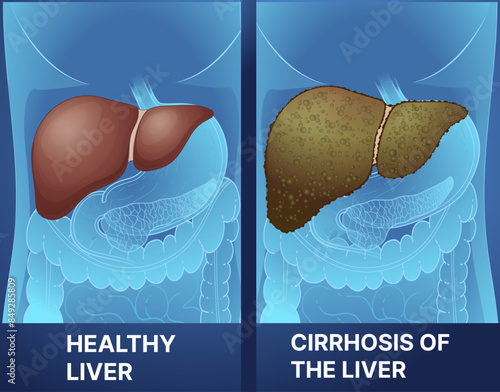 Human liver disease. Healthy liver, cirrhosis of the liver. Healthcare illustration. Vector illustration.