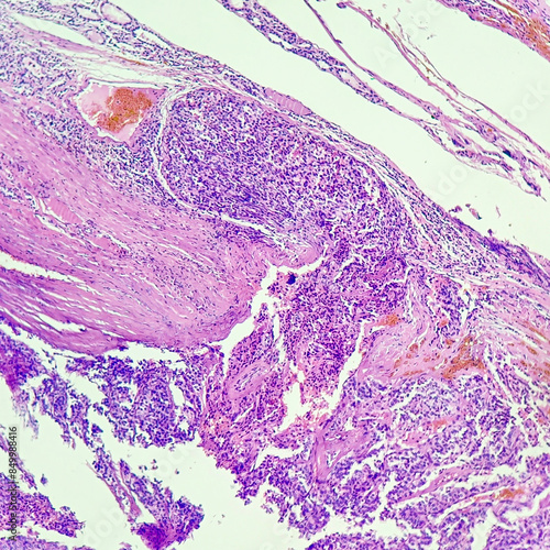 Camera photo of follicular thyroid carcinoma, showing capsular invasion, magnification 200x, photograph through a microscope