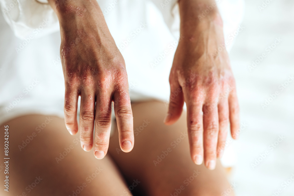 Fototapeta premium Psoriasis, a skin disease in a young woman.