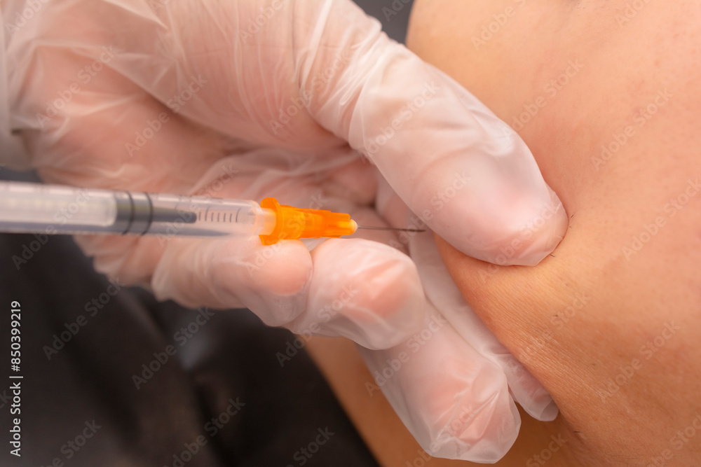 Masseter Jaw Botox, also known as Jawtox procedure - Close-up view of a medical professional administering a botox injection to a patient's jawline at an aesthetic clinic. Masseter Jaw Botox, also known as Jawtox procedure - Close-up view of a medical professional administering a botox injection to a patient's jawline at an aesthetic clinic.