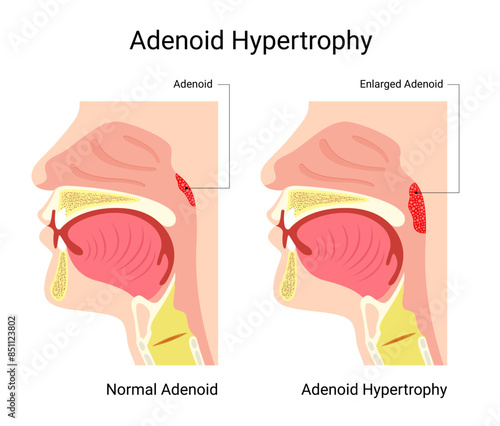 Normal adenoids and adenoid hypertrophy