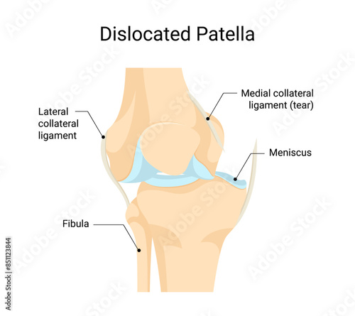 Dislocated patella diagram medical vector design