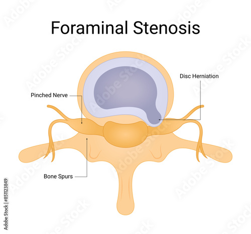 Diagram of foraminal stenosis design for medical