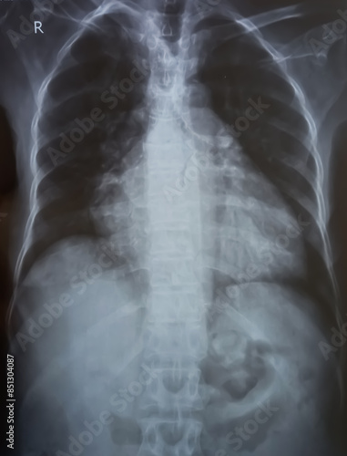 Chest x-ray image demonstrated heart, lungs, ribs, bones and muscles. Xray shown cardiomegaly in congestive heart failure.
